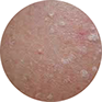 Keratosis