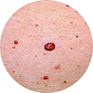 Cherry Angioma