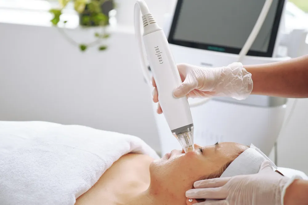 Potenza RF microneedling treatment at GlowUp MediSpa in Ottawa