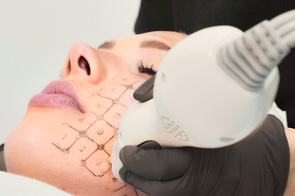 Thermage FLX treatment illustration with GlowUp MediSpa branding